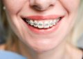 How is Invisalign Different to Traditional Braces? Key Comparisons Explained