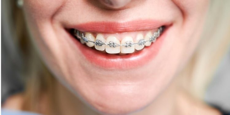 How is Invisalign Different to Traditional Braces? Key Comparisons Explained