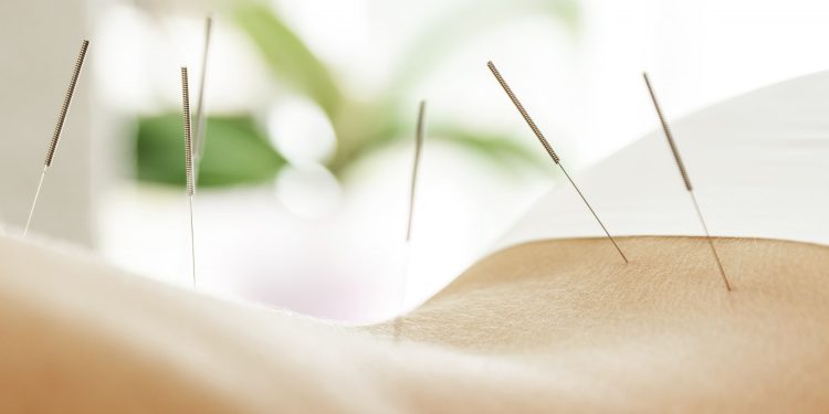 Discovering the Right Acupuncture Clinic for Effective Pain Relief